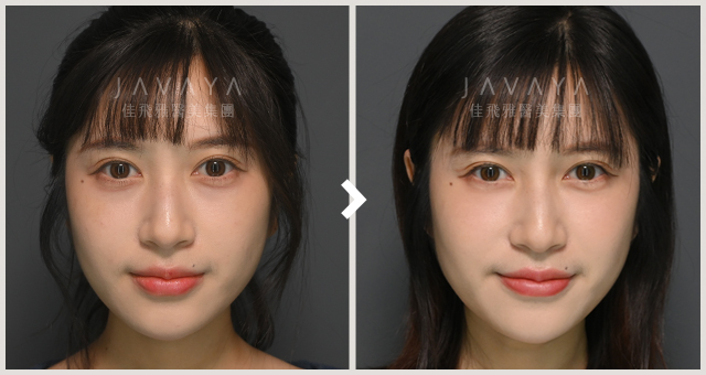 肉毒注射咀嚼肌｜見證案例_08